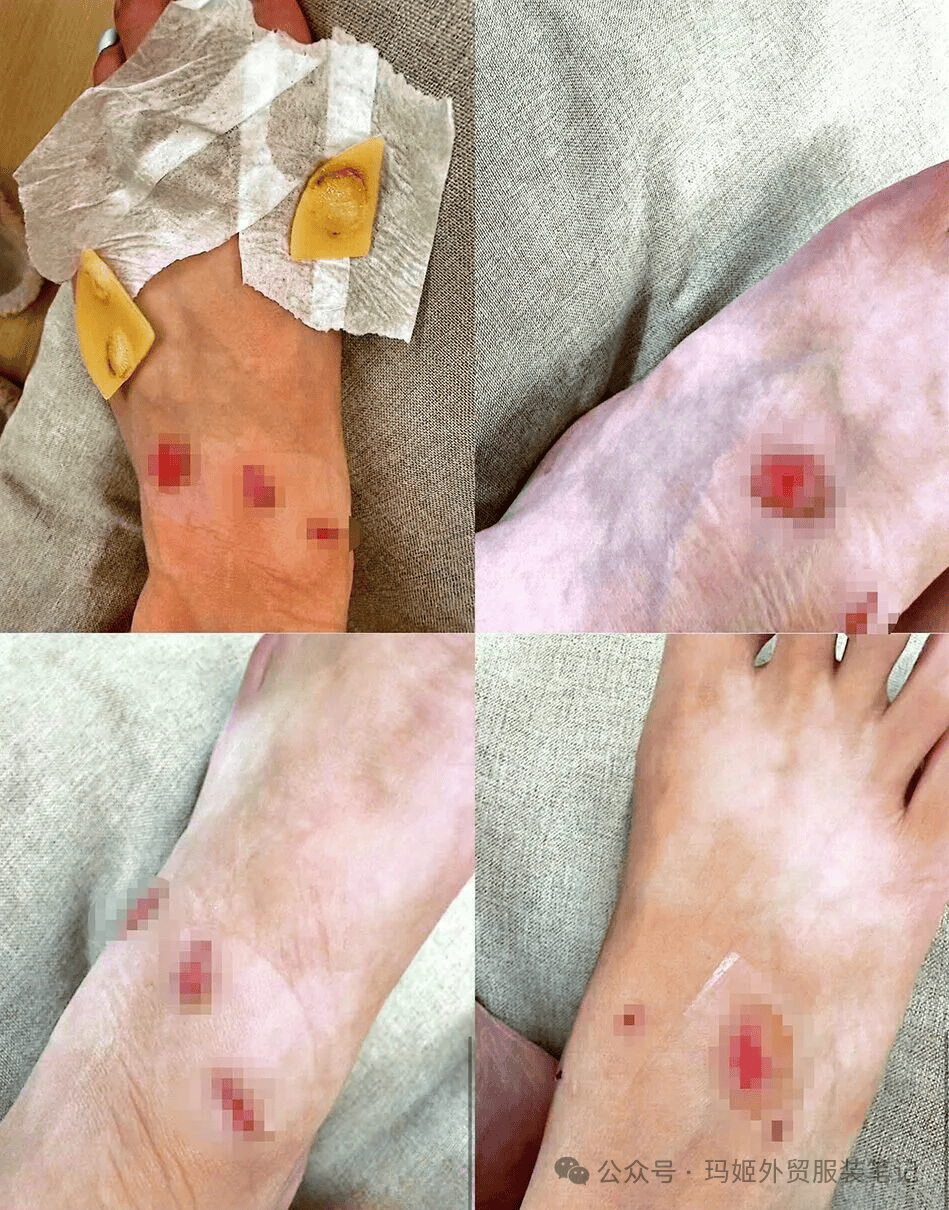 后双脚多处破皮要求退款被拒客服:不退只能换bsport中国女子购近万元LV运动鞋穿(图1) 后双脚多处破皮要求退款被拒客服:不退只能换bsport中国女子购近万元LV运动鞋穿(图1)